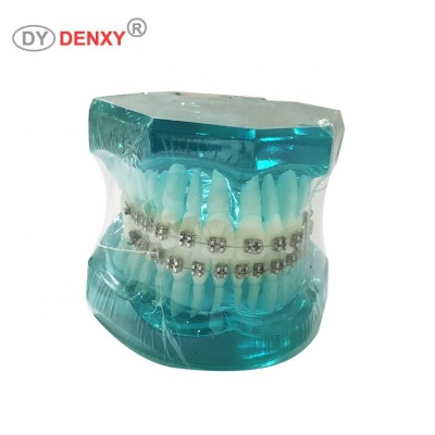 Denxy Dental Abnormal Teeth Treatment case model with Fixed Braces