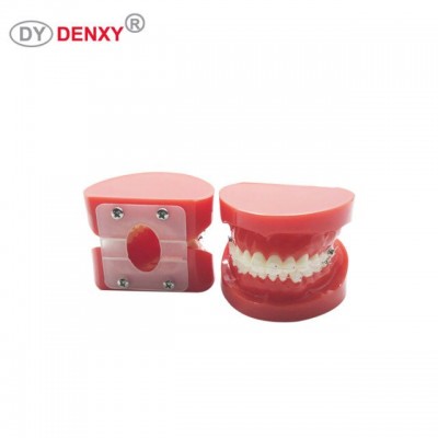 Denxy Orthodontic model for Patient learn Tooth Orthodontic Model with Braces Dentist Teach Dental