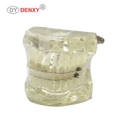 Denxy Dental ceramic orthodontic brackets tooth model