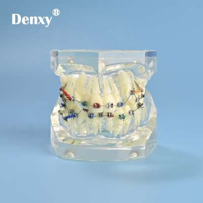 Denxy Dental clear color Dental Model Teeth Dental Instruction Orthodontic teeth Model with Metal  Orthodontic Bracket Color Tie